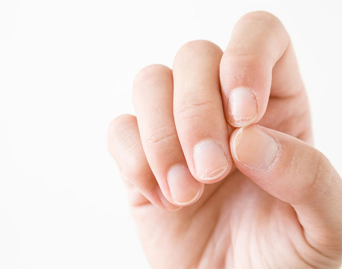 5 ways to strenghten brittle nails with home remedies