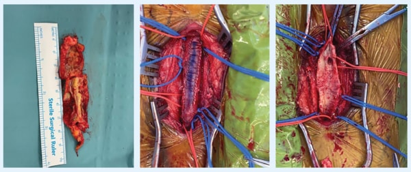 Femoral endartectomy and patch repair - SingHealth Duke-NUS Vascular Centre