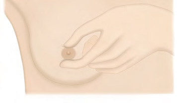 nipples discharge