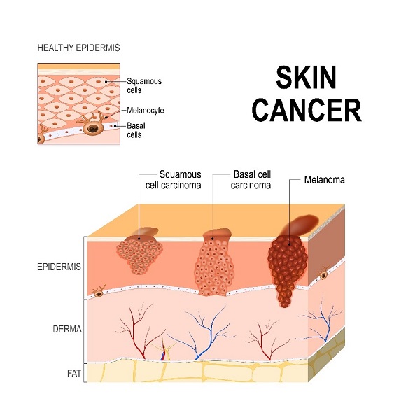 skin cancer - conditions & treatments