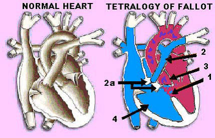Normal heart vs tetralogy of fallot