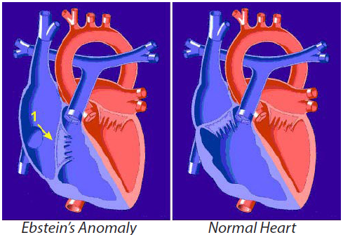 ebstein's anomaly versus normal heart illustration