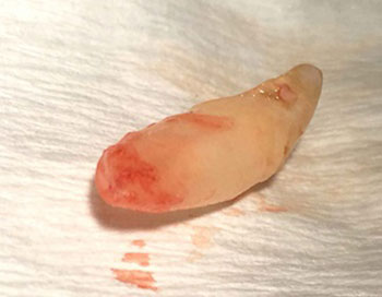 storing of  tooth after avulsion