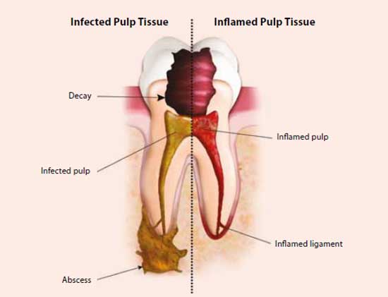 Diagram of Infected Versus Inflammed Pulp Tissue by the National Dental Centre Singapore