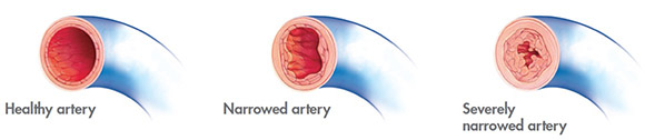 pulmonary arterial hypertension conditions & treatments