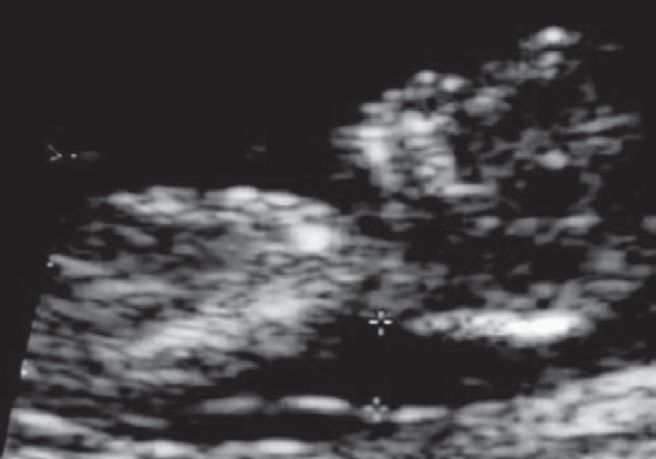 Figure 3. Thickened nuchal translucency (measurements within the 2 white + markings) in a baby with Down Syndrome