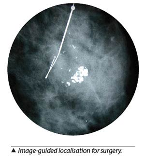 breast cancer treatment - image-guided localisation for surgery