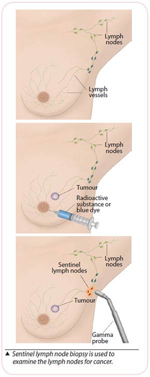 Breast Cancer treatment-Sentinel Lymph Node Biopsy (SLNB)