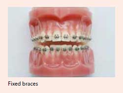 Fixed braces treatment for malocclusion available at National Dental Centre Singapore.