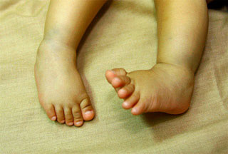 clubfoot in children conditions & treatments 