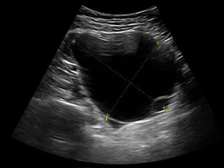 pelvic ultrasound scan for endometriosis and ovarian cysts