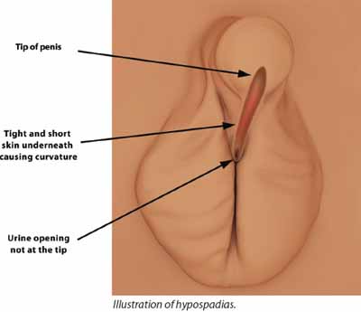 Treatment for penis abnormality (hypospadia) - KKH
