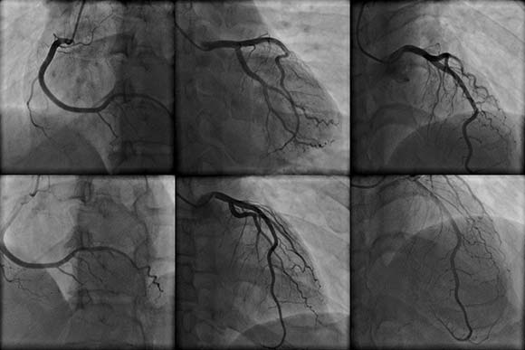 coronary angiography conditions and treatments