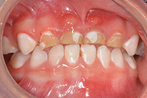 severe early childhood caries conditions & treatments