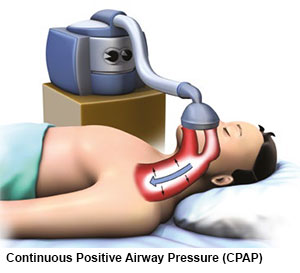 Continuous Positive Airway Pressure (CPAP) - Obstructive Sleep Apnoea (OSA) Conditions and Treatments