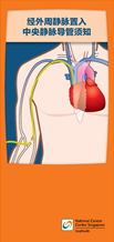 Guide to Peripherally Inserted Central Catheter_Chi.png